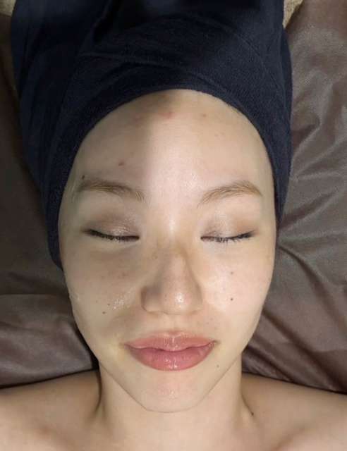 光フェイシャルの術前の比較画像