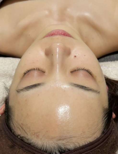 ララピールの術後の比較画像