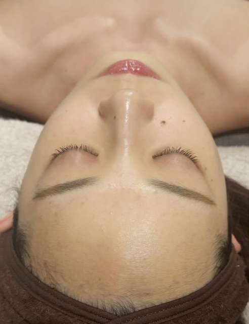 ララピールの術前の比較画像