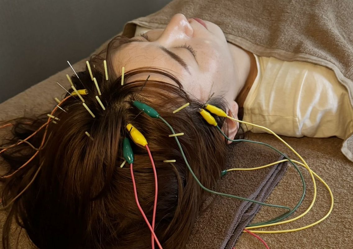 鍼ヘッドスパの施術イメージ写真