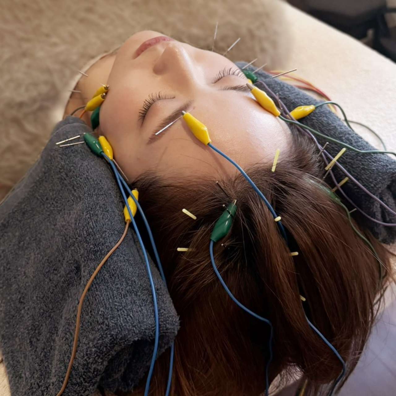 美容鍼の施術イメージ写真