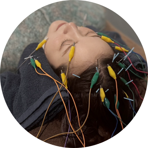 美容鍼の施術イメージ写真